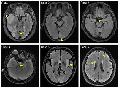 Anti-GABAB receptor encephalitis: clinical and laboratory characteristics, imaging, treatments and prognosis